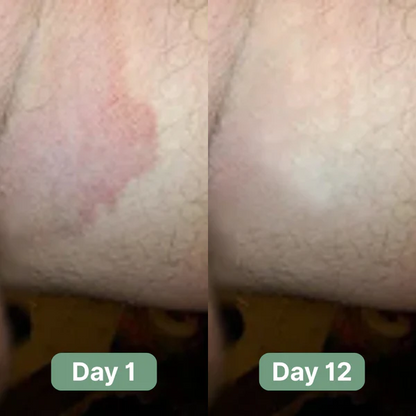 Cougex® Antifungal Cleansing Bar