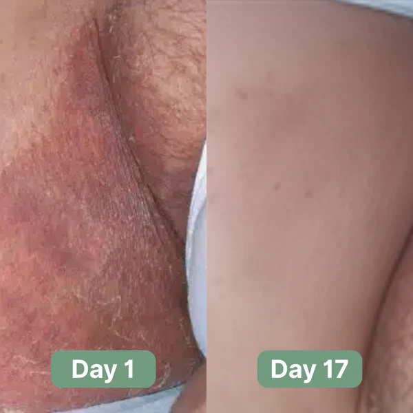 Cougex® Antifungal Cleansing Bar